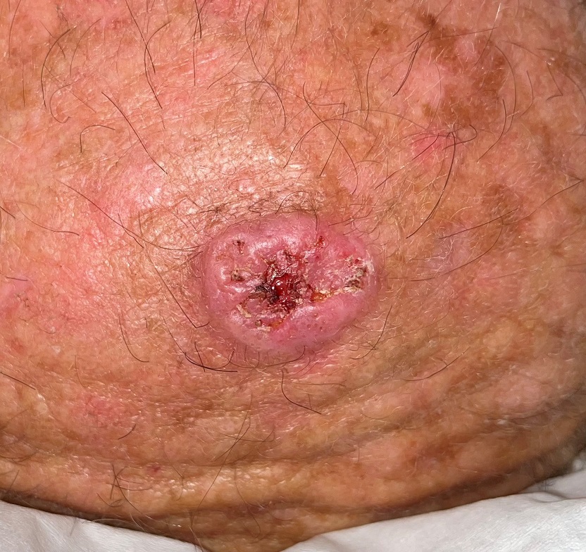 Squamous cell carcinoma skin cancer